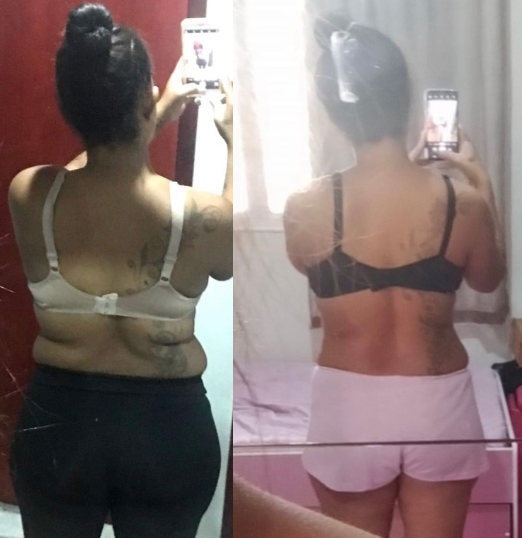 Vanessa, 36 anos — antes e depois com o LIPO10X