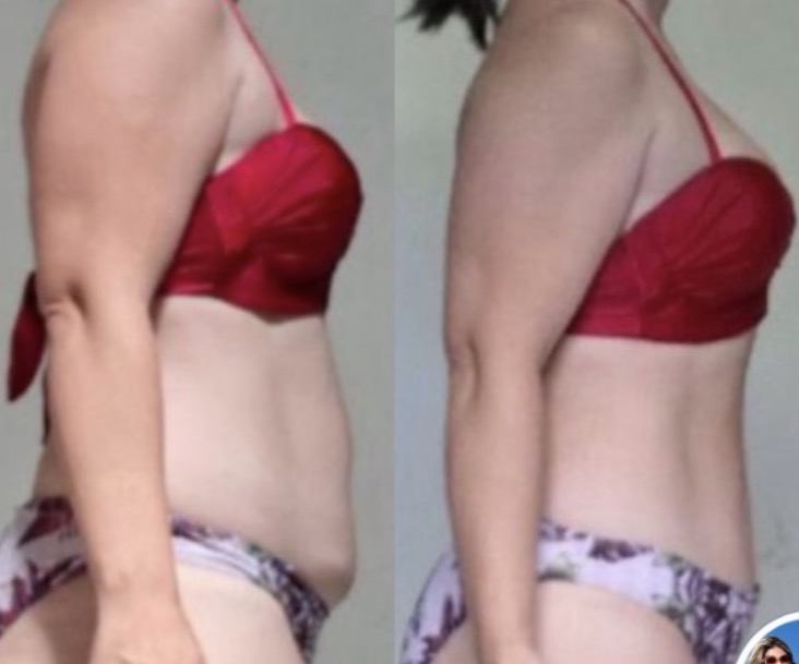 Emilia, 36 anos — antes e depois com o LIPO10X