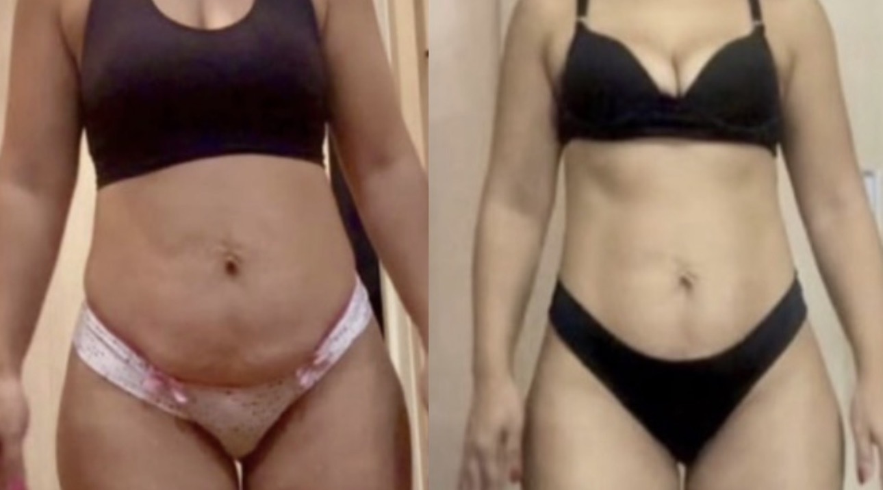 Gleiye, 40 anos — antes e depois com o LIPO10X