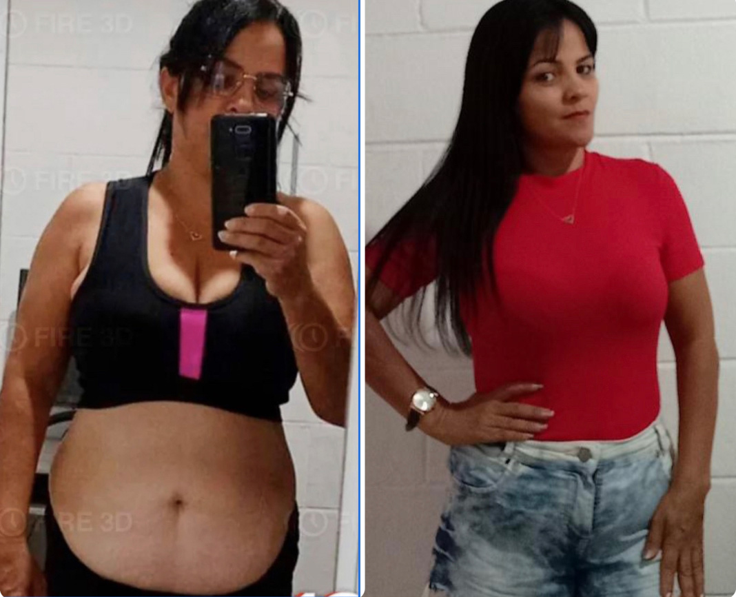 Rute, 40 anos — antes e depois com o LIPO10X
